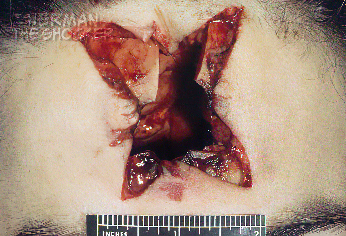 A contact entrance wound of the head showing wide separation of the wound edges