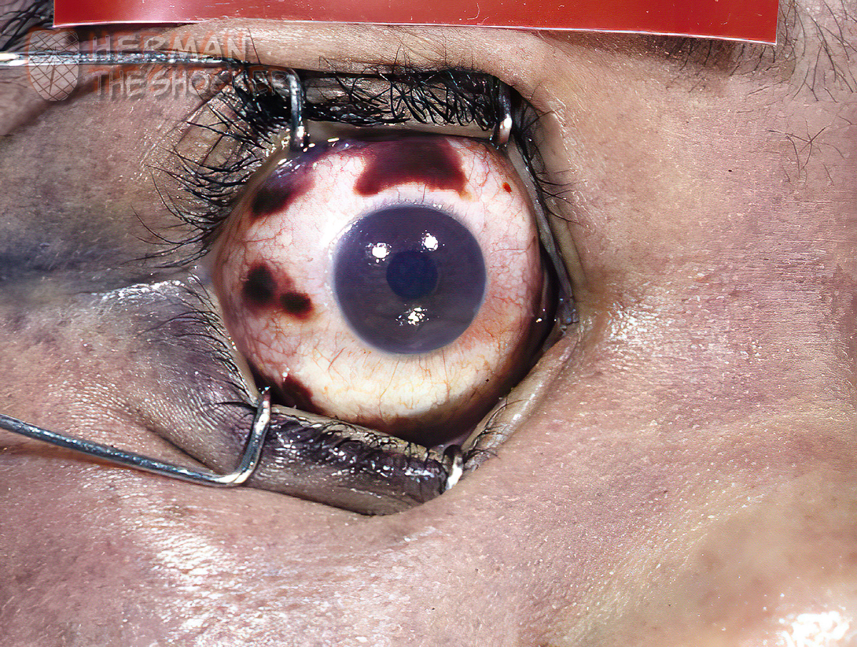 Scleral hemorrhages in the eye of a strangled woman