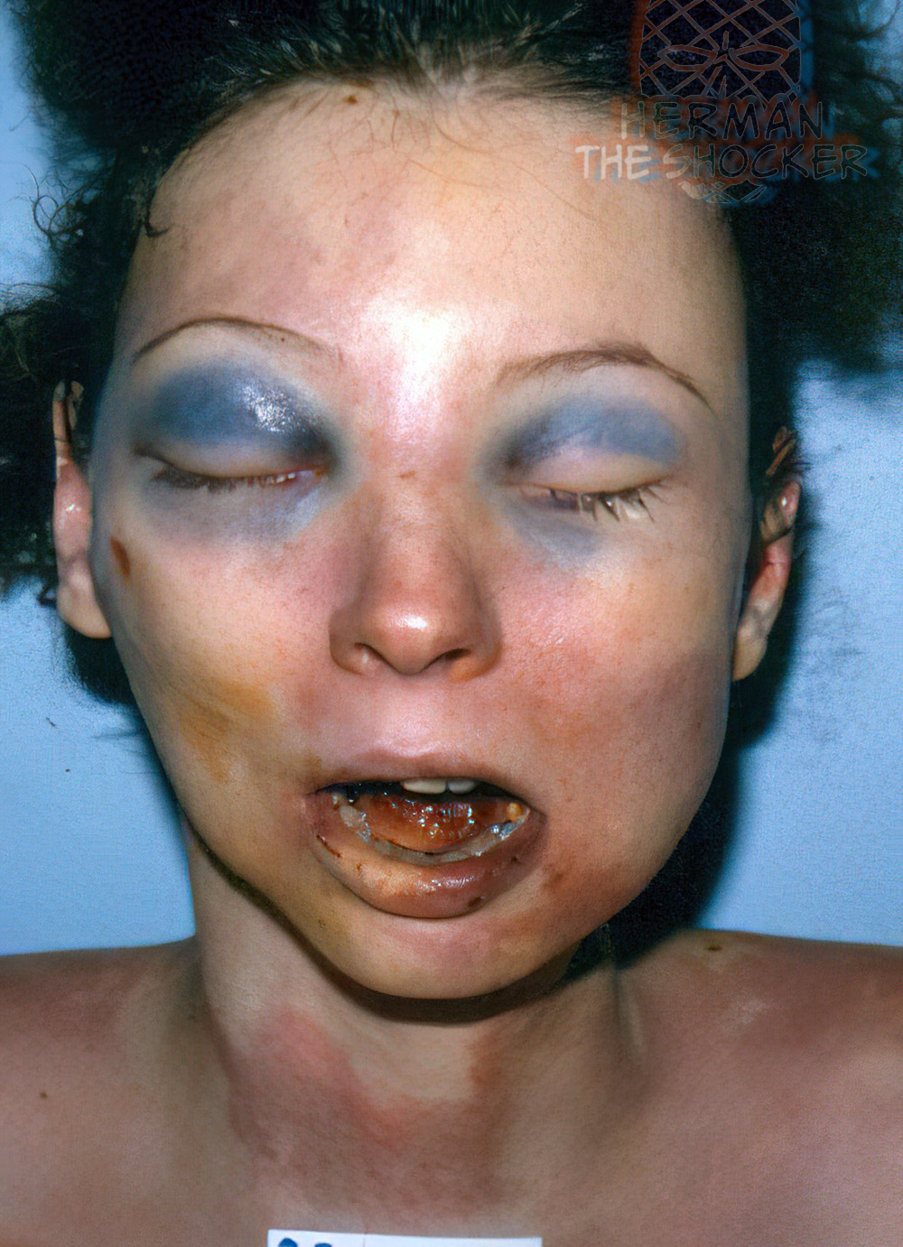 Raccoon eyes on a suicide victim