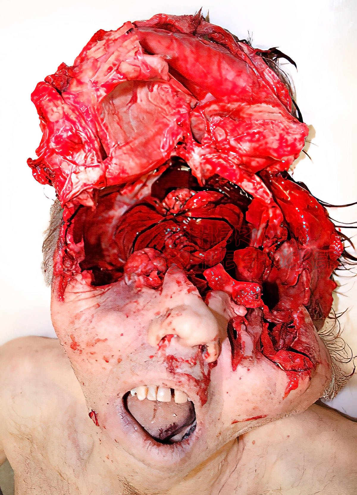 Reconstruction of devastating head injuries