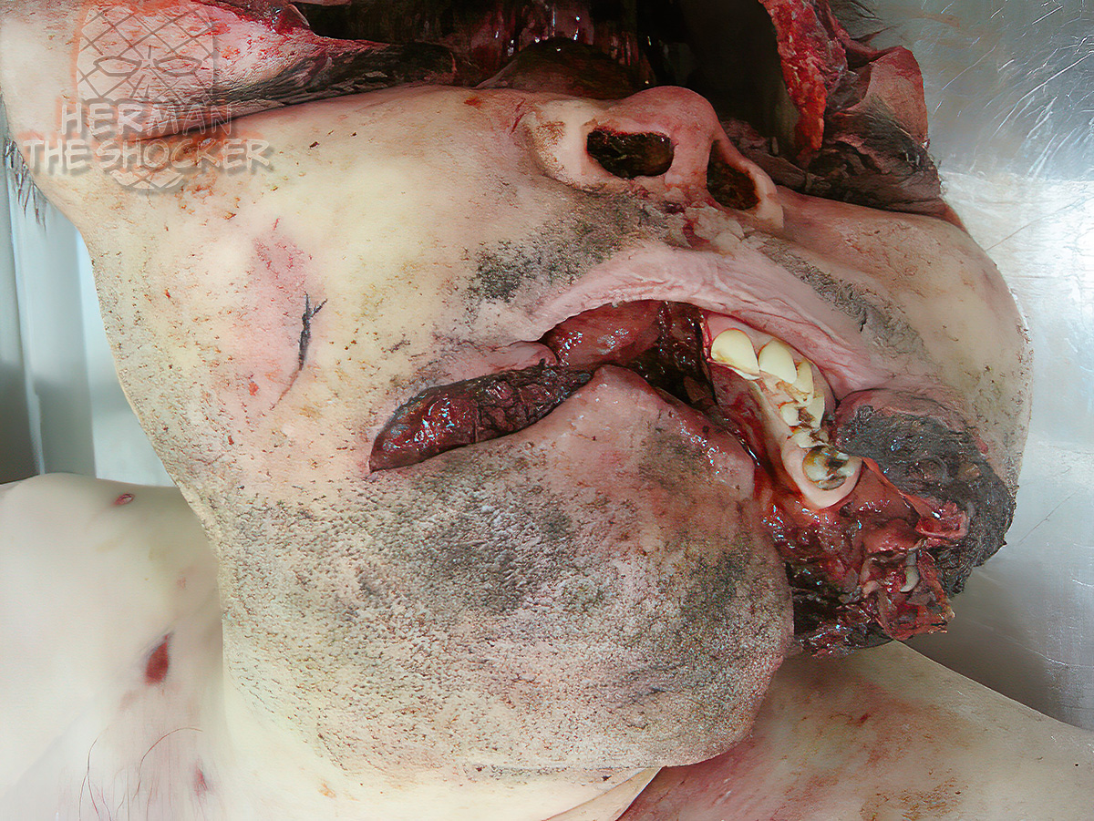 Facial injury resulting from high-velocity accident