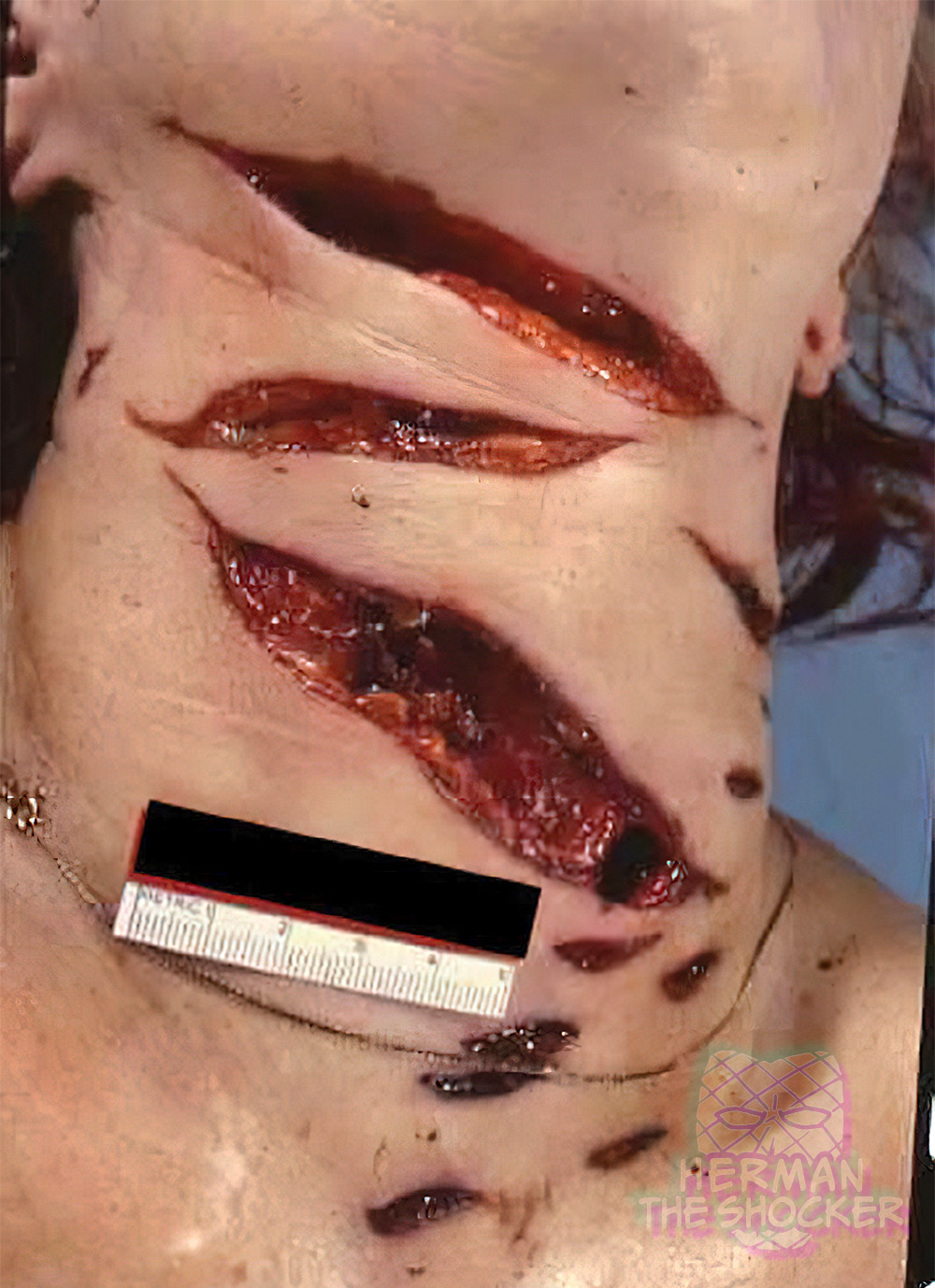 Homicidal incised wounds of the neck inflicted from the front