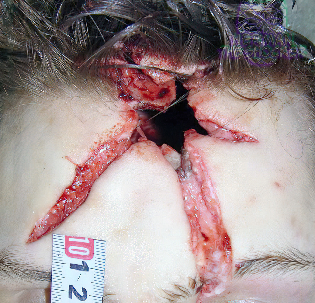 Gunshot entrance wound on the forehead