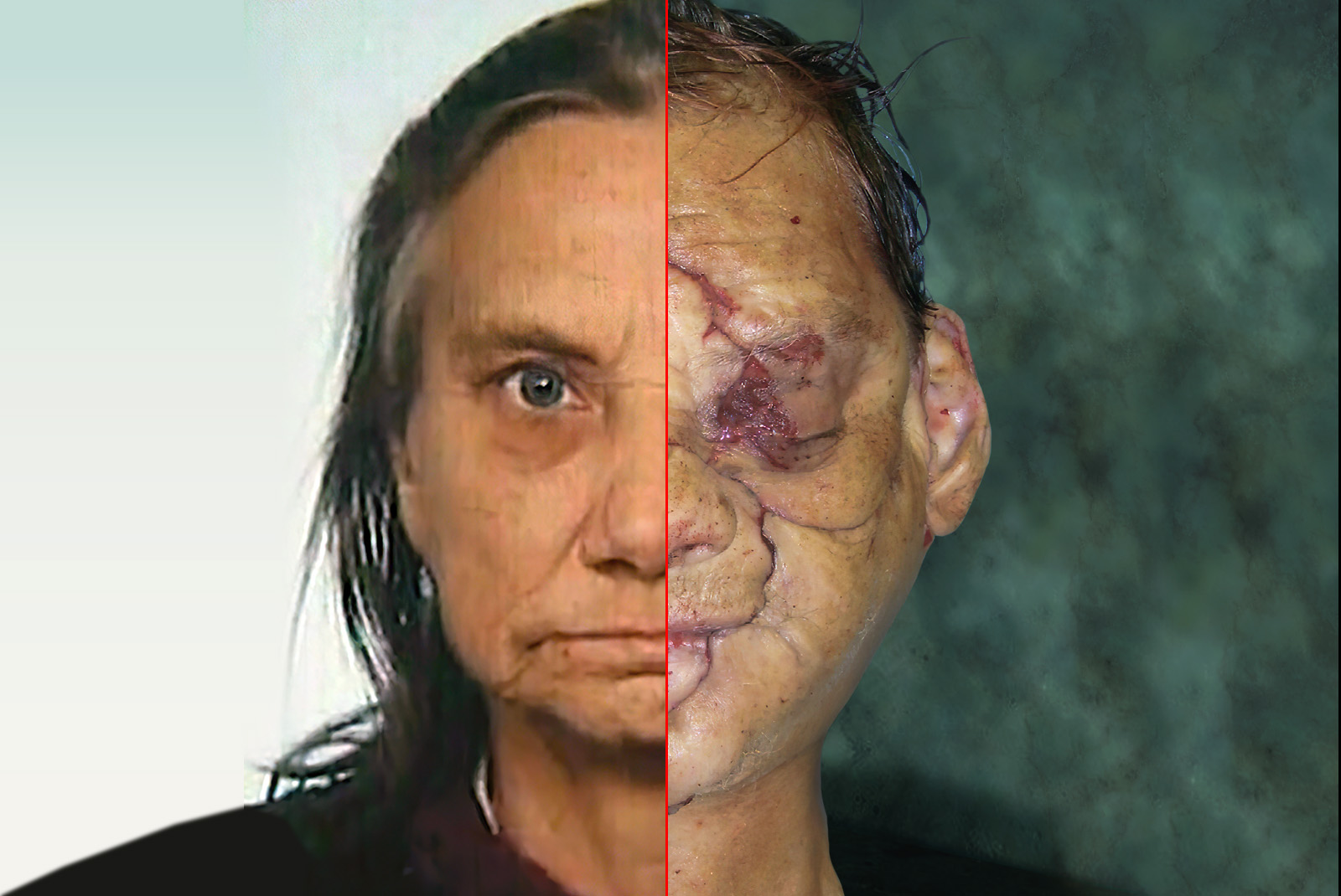 A facial reconstruction and identification technique for seriously devastating head wounds