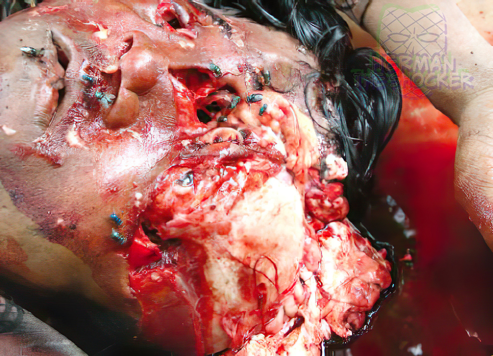 Crush laceration of the head