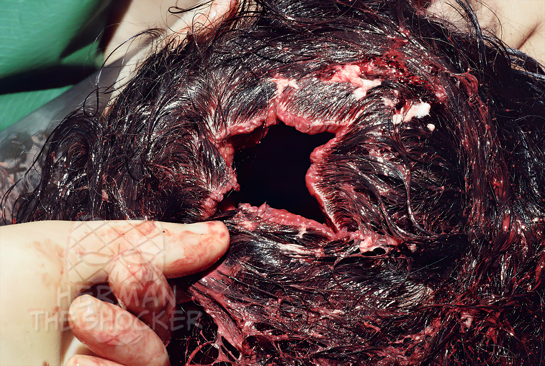 Shotgun Exit Wound Herman The Shocker