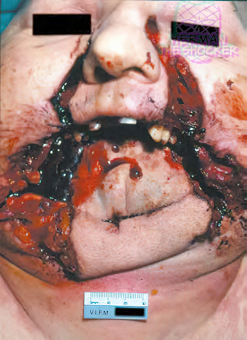 Facial splitting from an intraoral discharge