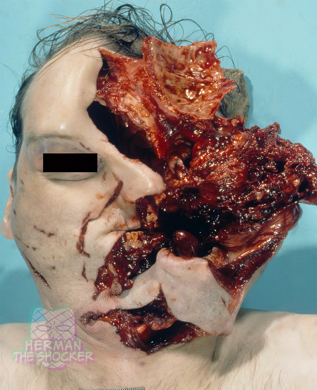 A contact shotgun wound of the lower chin