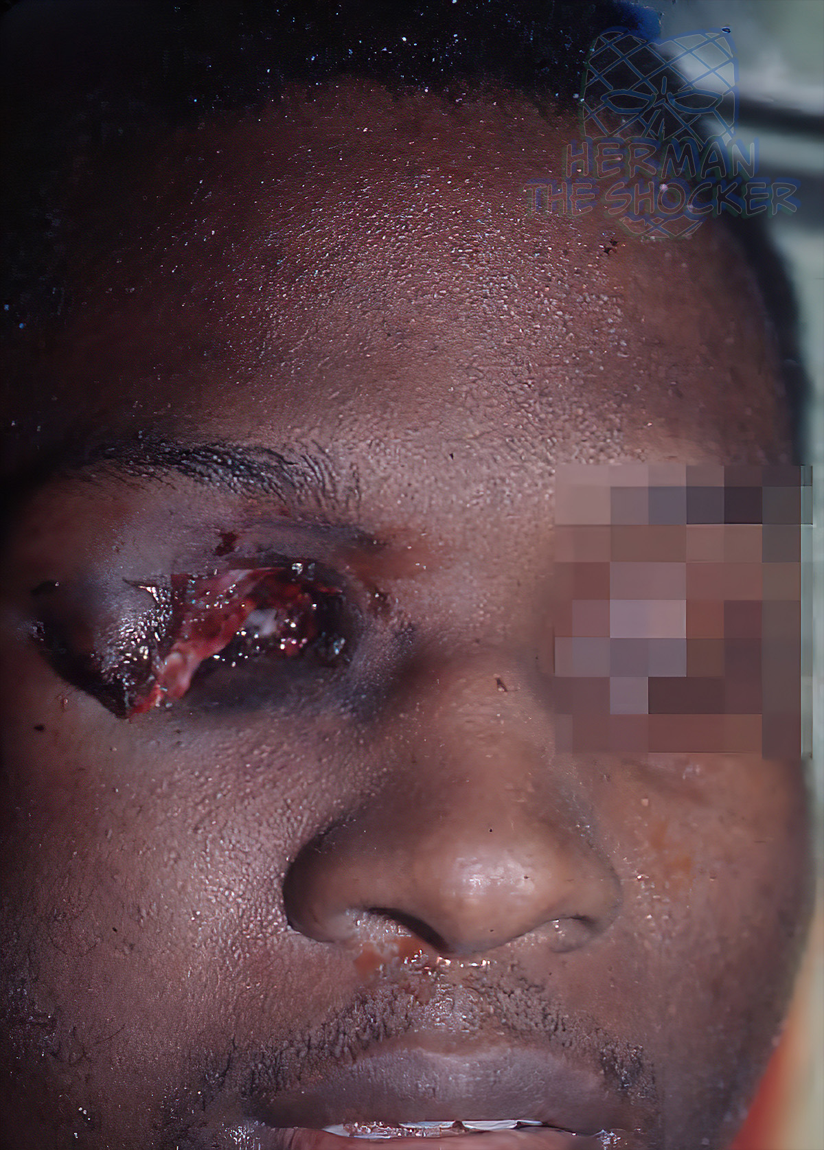 Contact gunshot wound to the eye