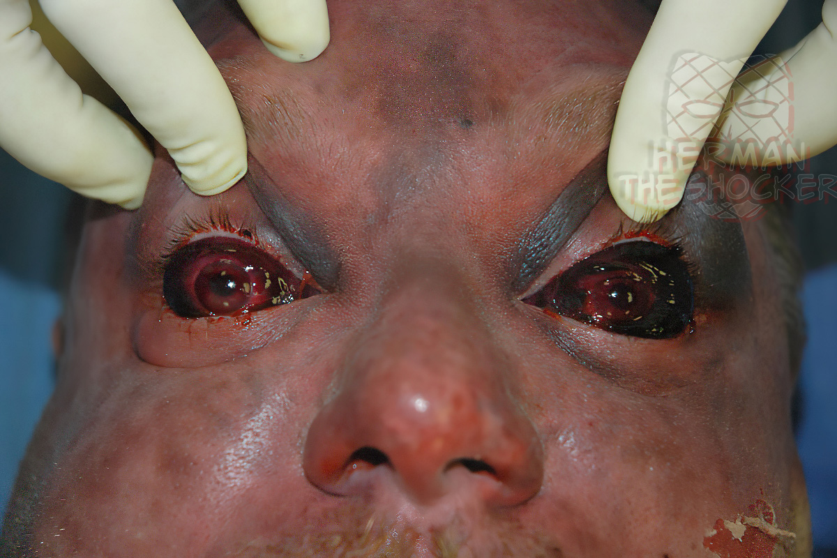 Decomposed sclera showing hemorrhagic discoloration of the whites of the eyes