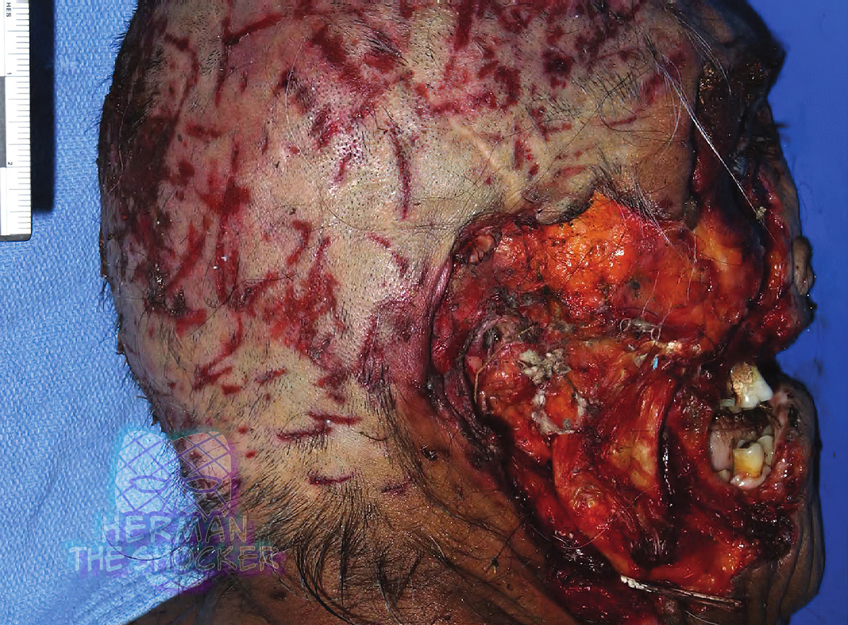 Postmortem carnivore activity around the mouth of a decedent