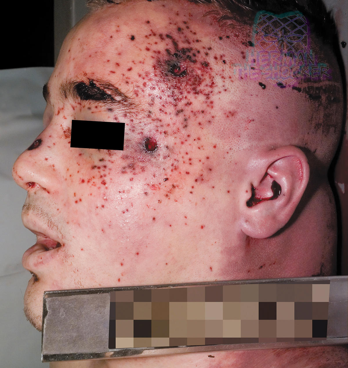 Stippling around gunshot entrance wounds of the face