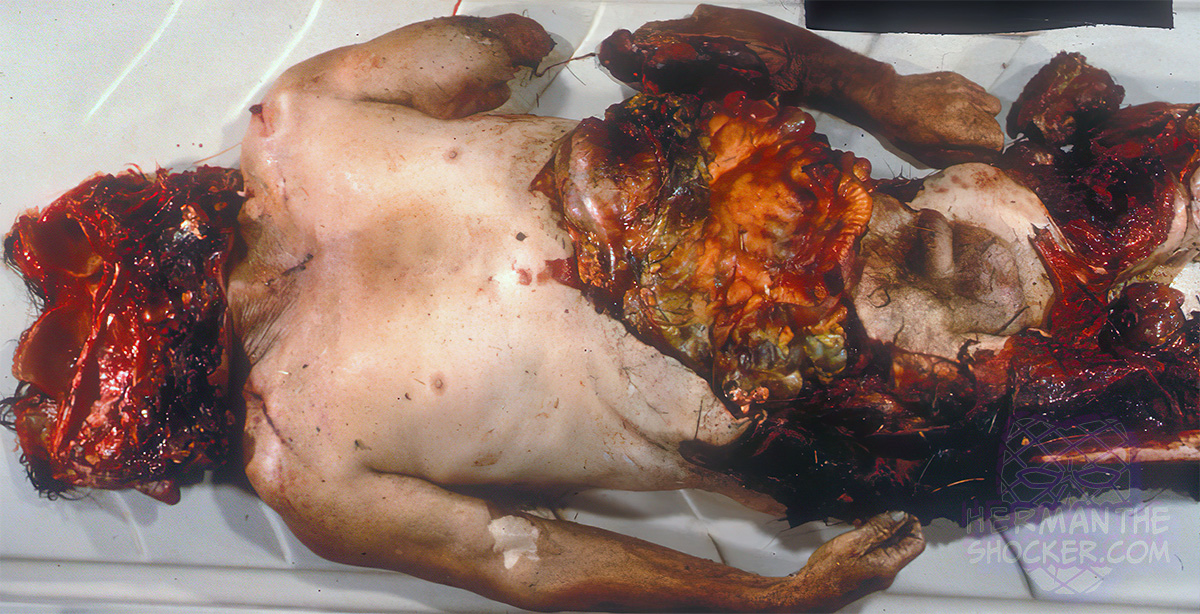 Fatal chop injuries after falling off a tractor