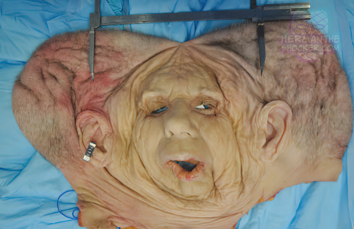 Facial Allograft Technique in Facial Reconstruction