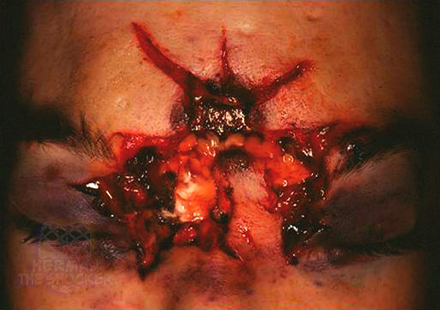 A hard-contact gunshot wound of the head