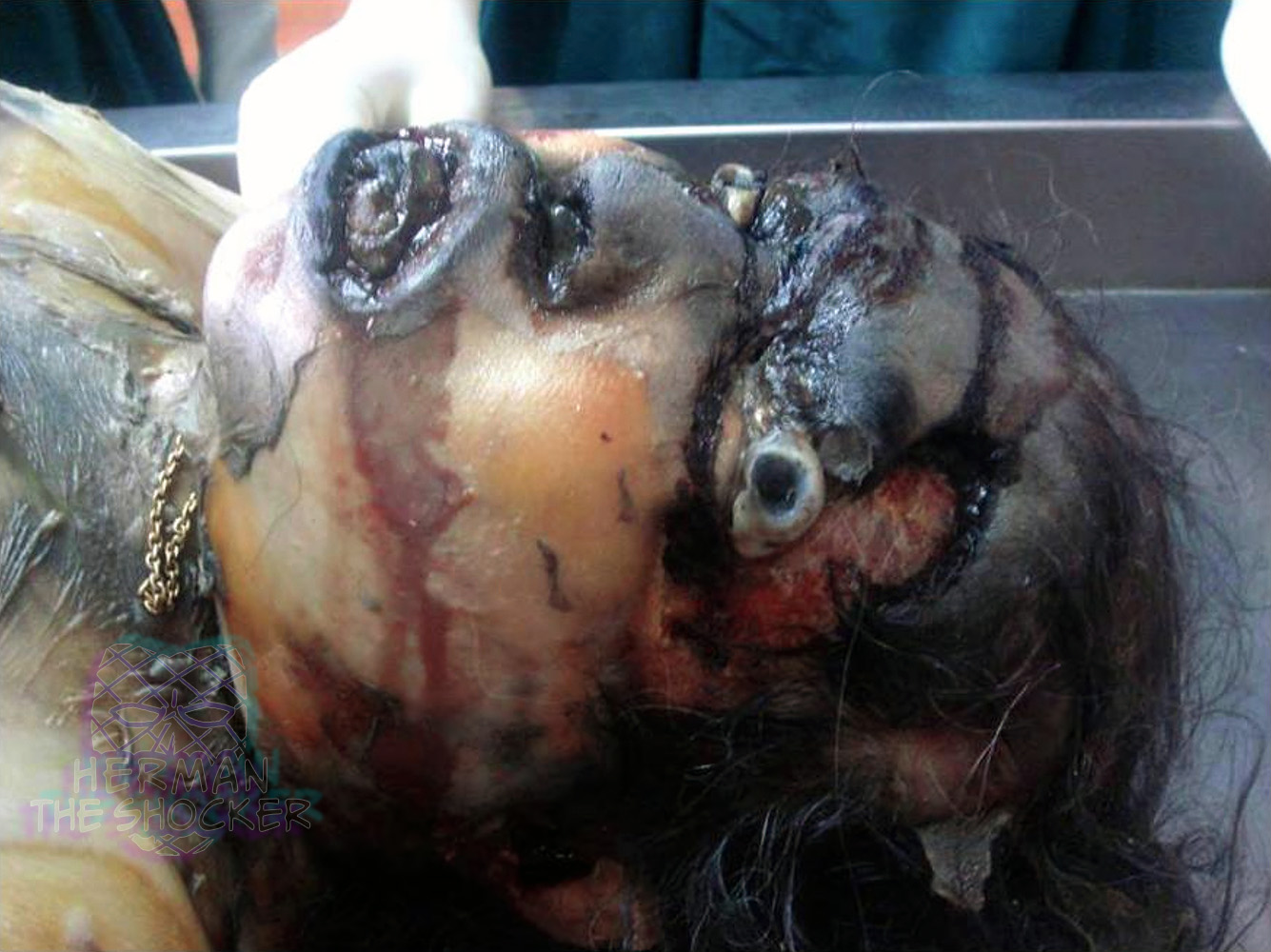 Bulging eyes, lips and face with protrusion of the tongue