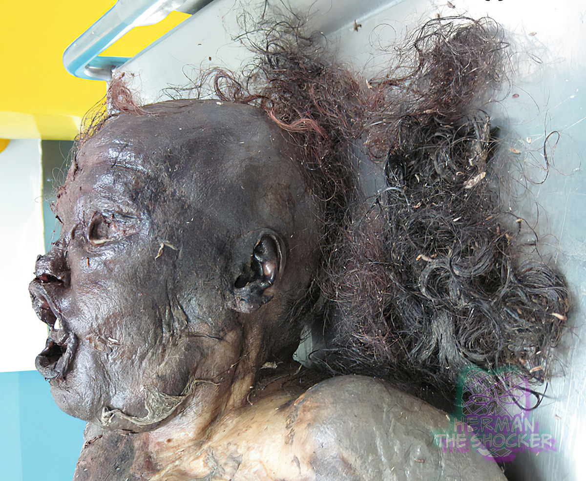 Putrefaction with skin slippage is also associated with loss of hair