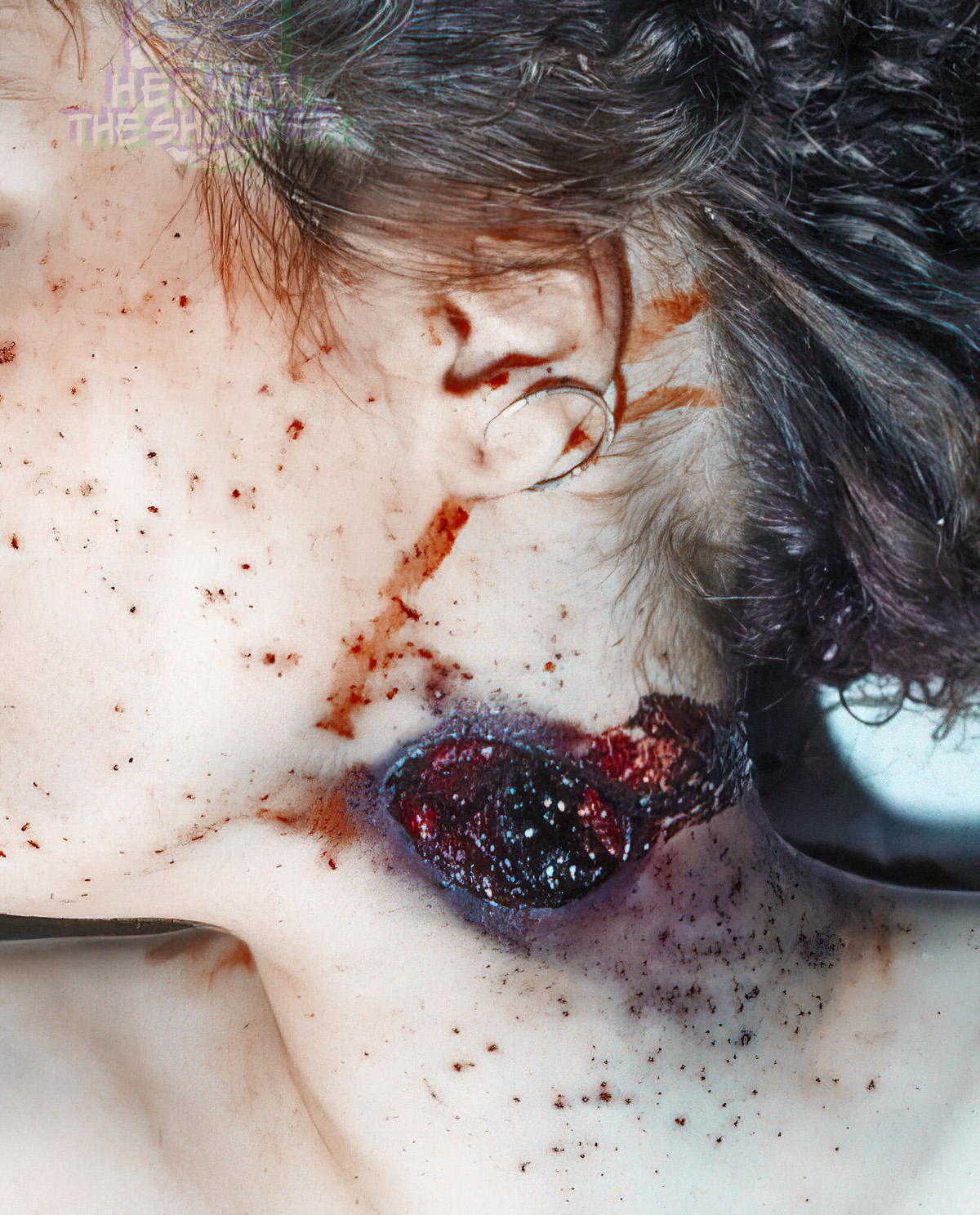 Shotgun shot wound