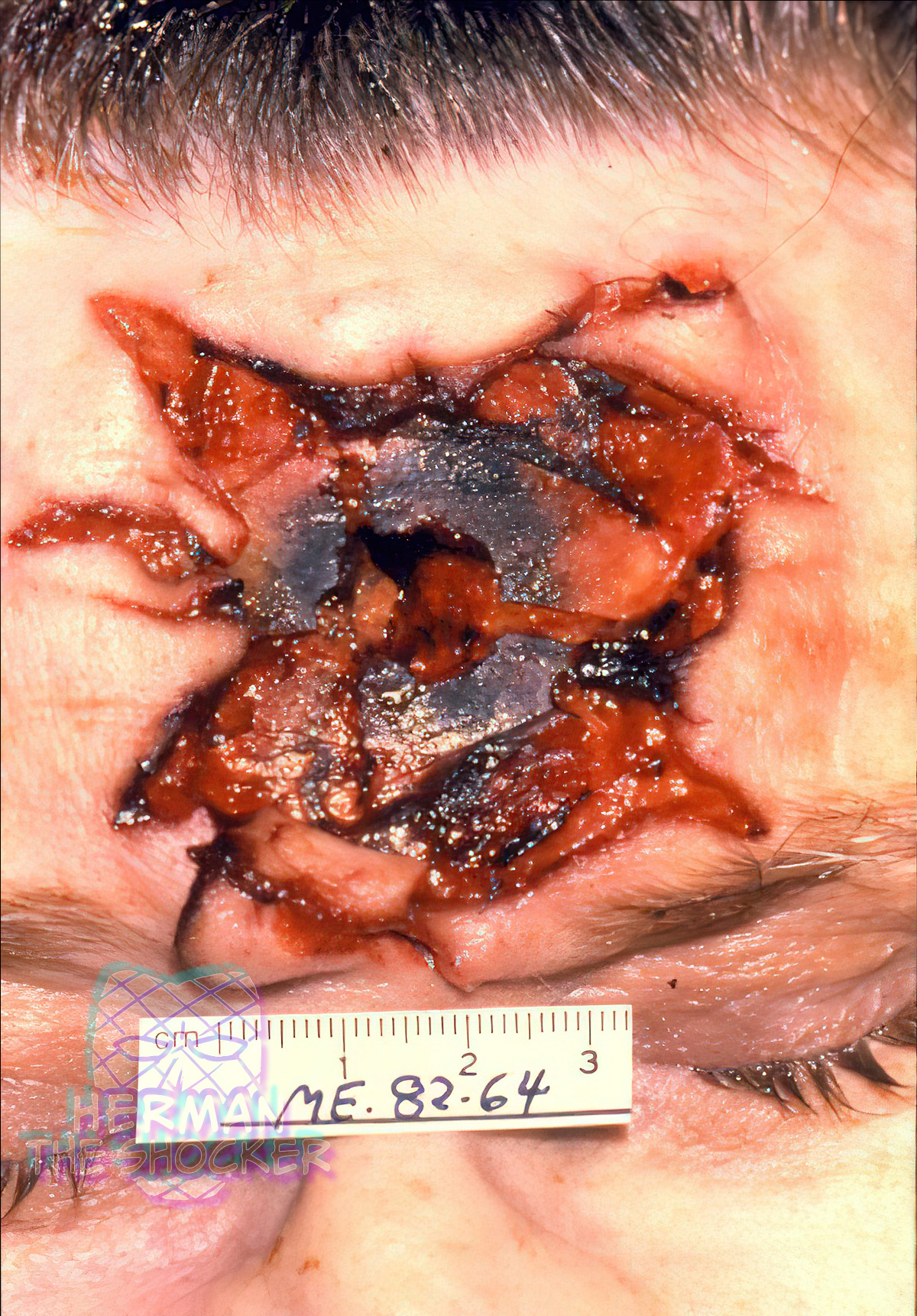 Stellate wound