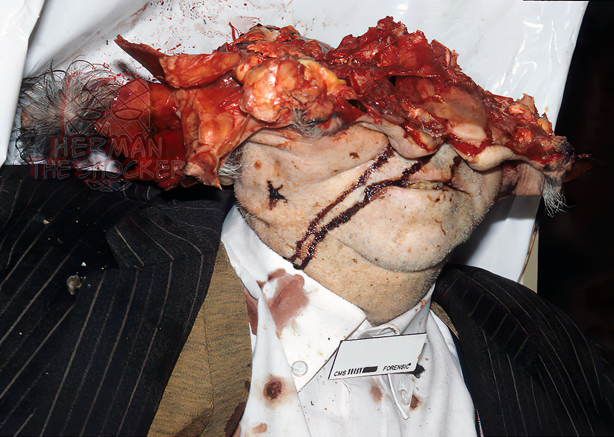 Destruction of most of the head from a contact shotgun wound