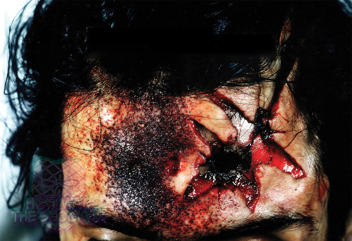 Stellate-shaped contact wound to the head