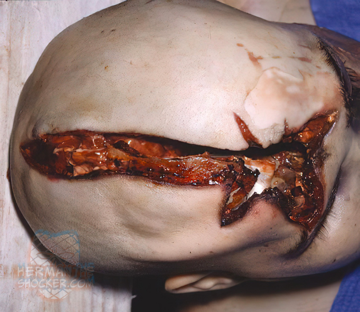 A gaping stellate wound on the forehead