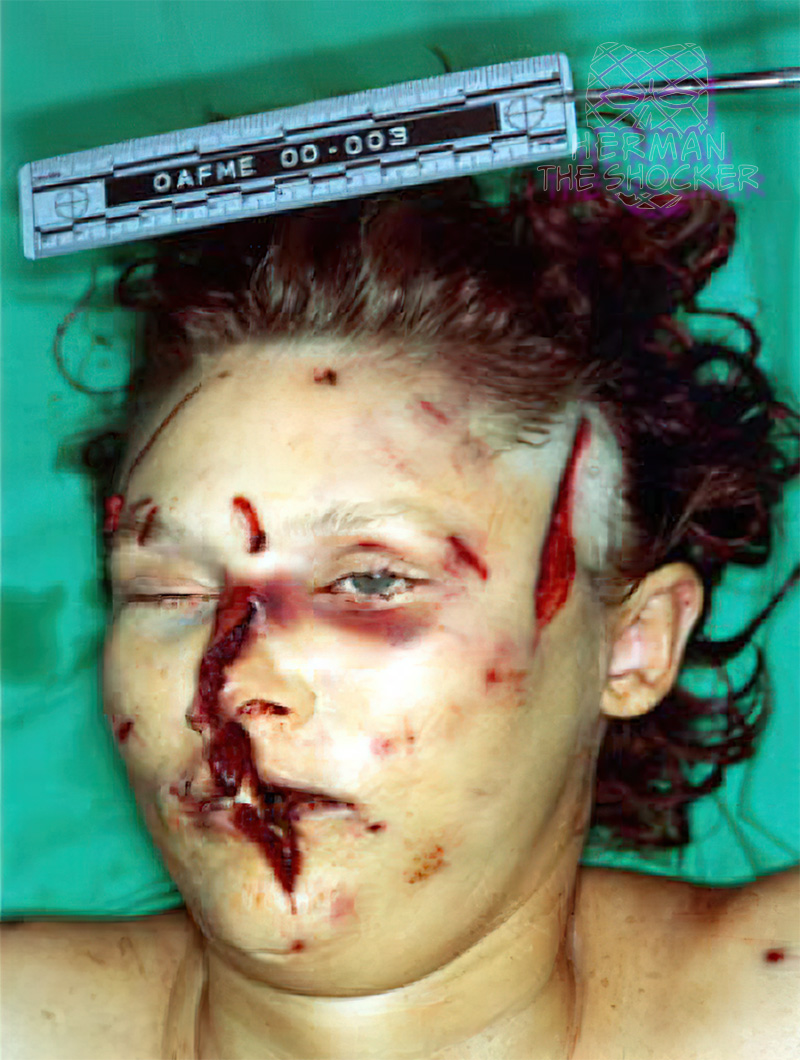 Cuts on woman’s face