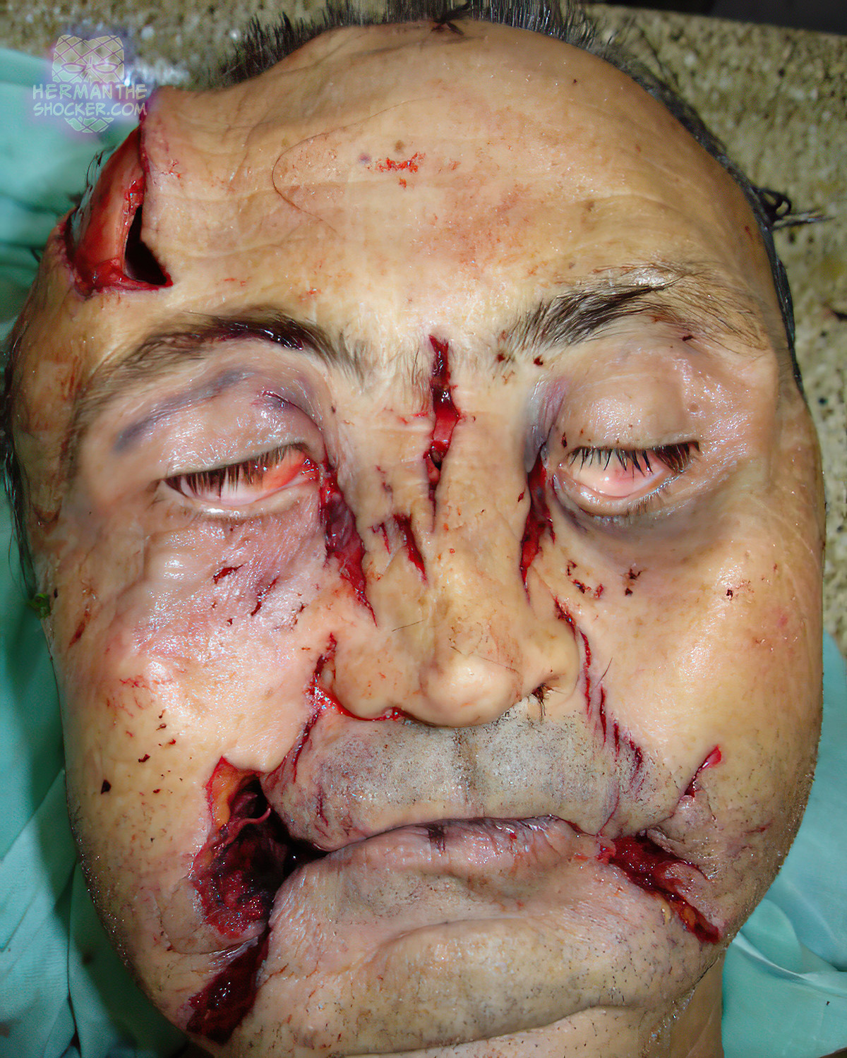 Linear tears on face from the rapid expansion of departed gases from an intraoral gunshot