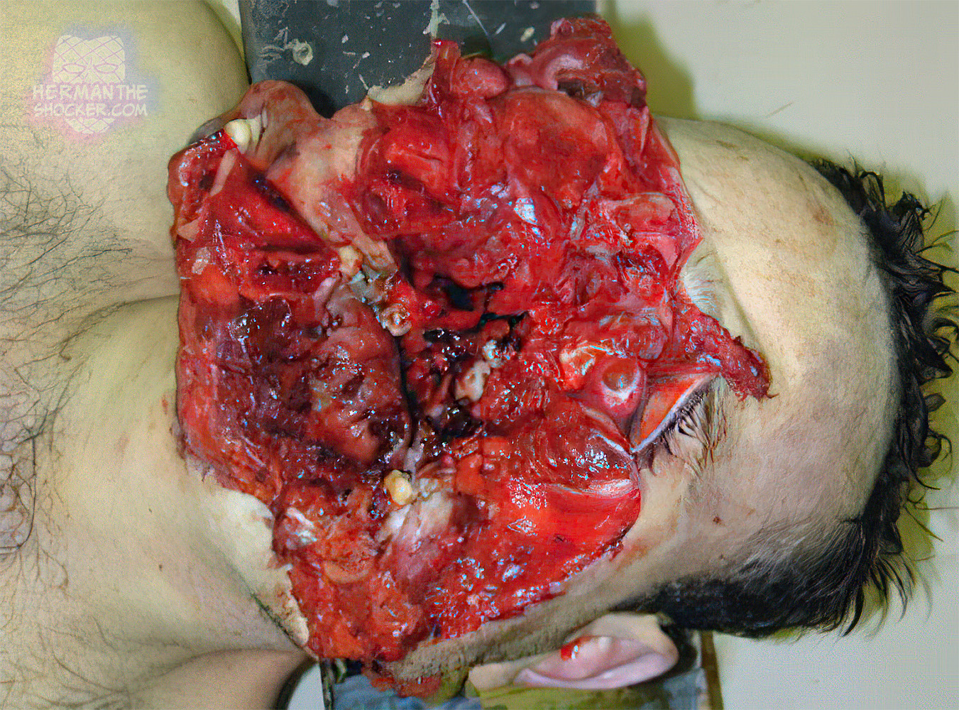Contact wound under the chin from a 12 gauge shotgun
