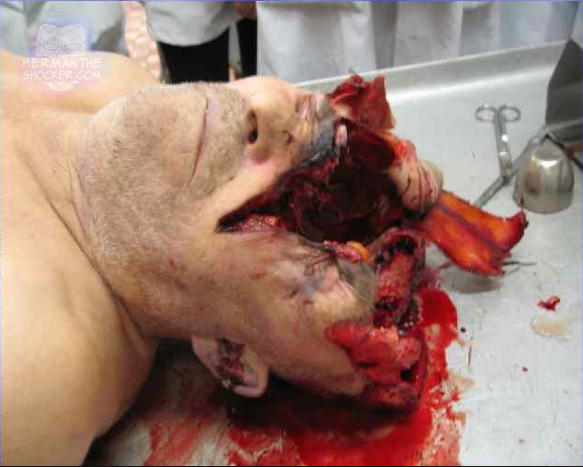 Gunshot wound to the head