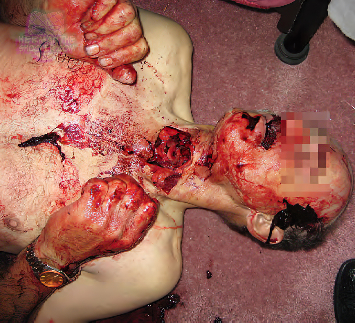 Suicide by multiple sharp-force injuries with broken glass