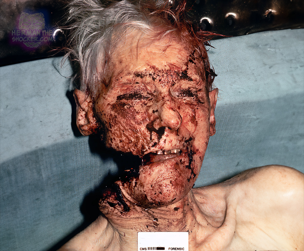 A suicide using a chainsaw to cut into the right side of the face