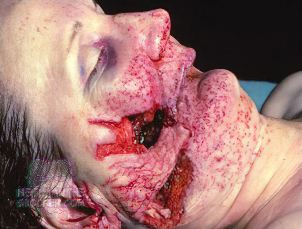 Gunshot wound from a .357 Magnum