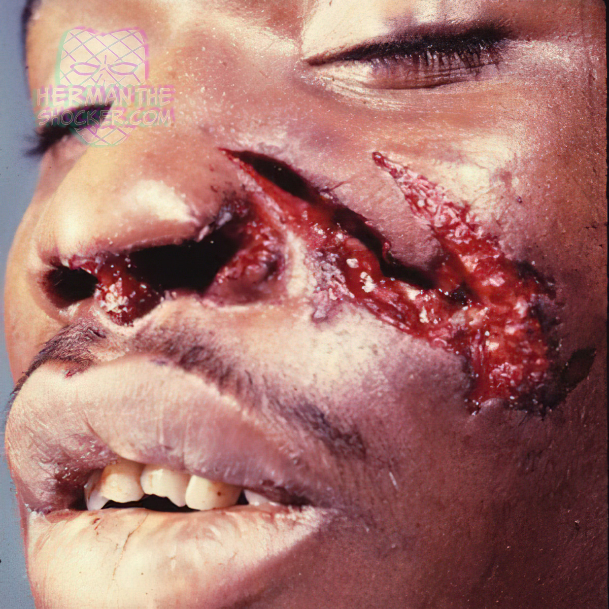 Tangential gunshot wound of the left cheek from a 9 mm bullet