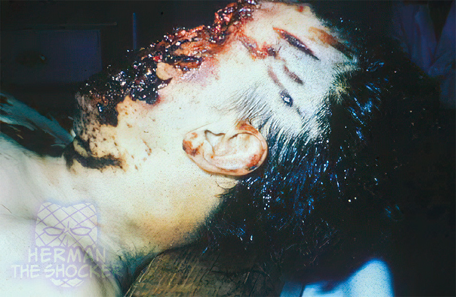 Facial injuries sustained when a letter bomb exploded as it was being opened