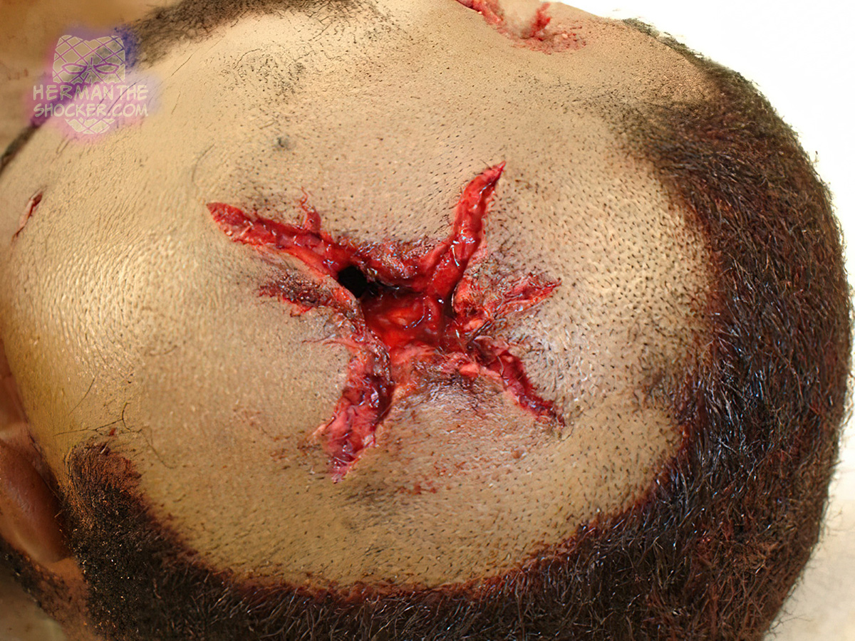 Contact-range gunshot wound on the head