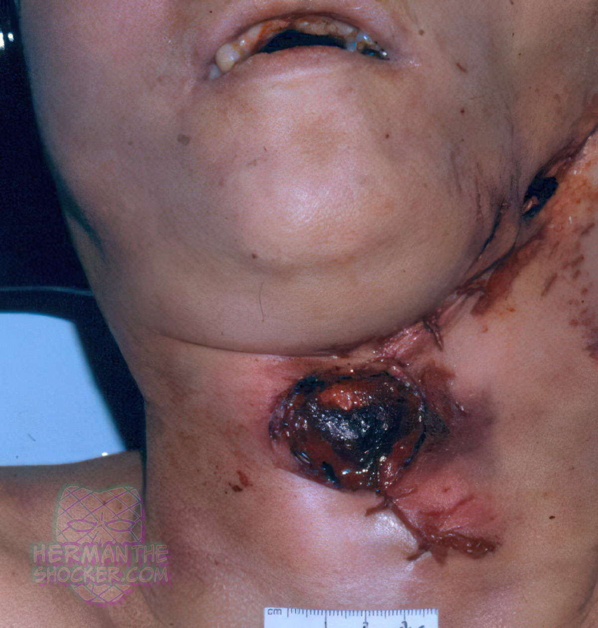 Gunshot wound on the neck