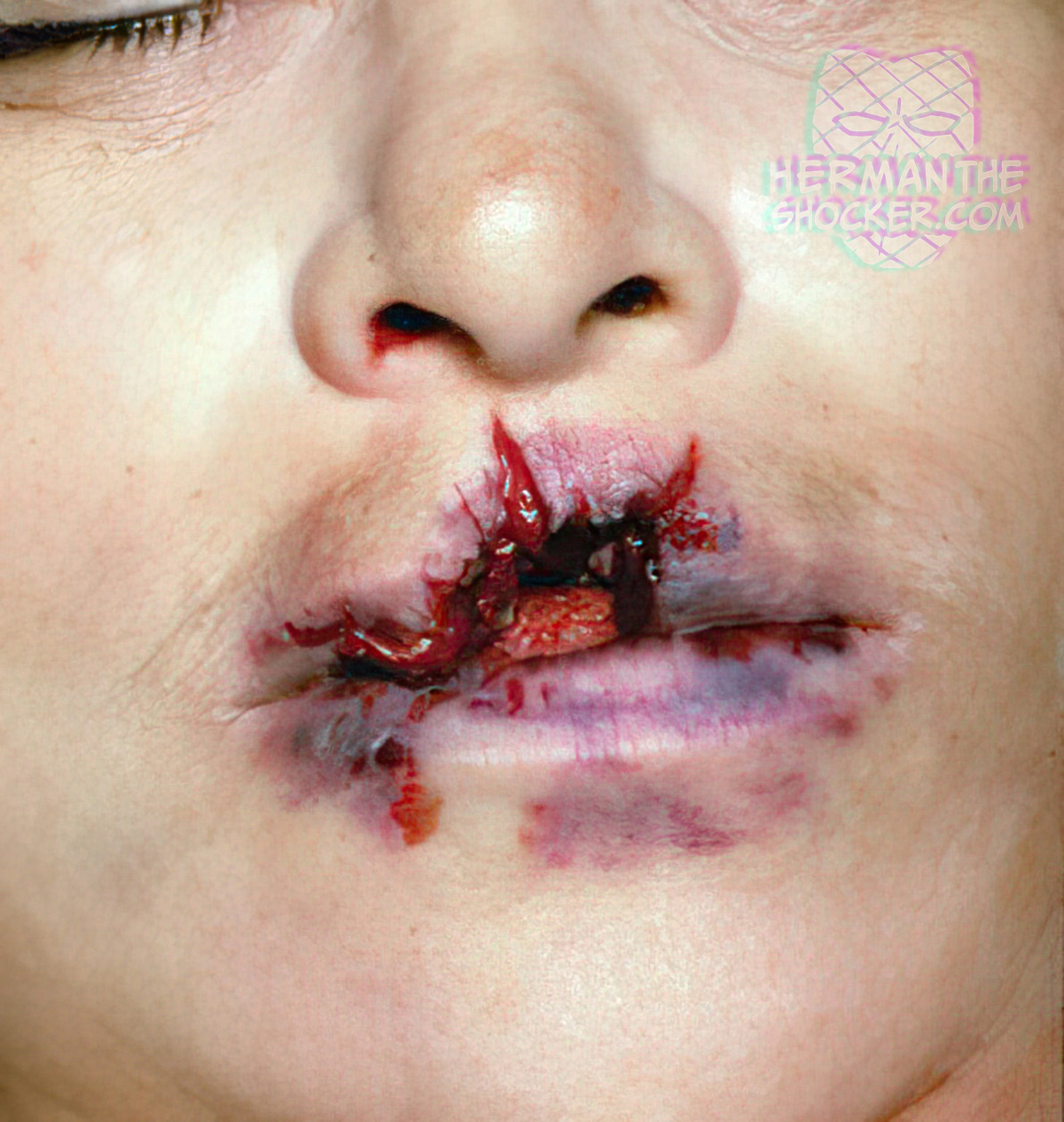 Stellate entrance wound on the lip