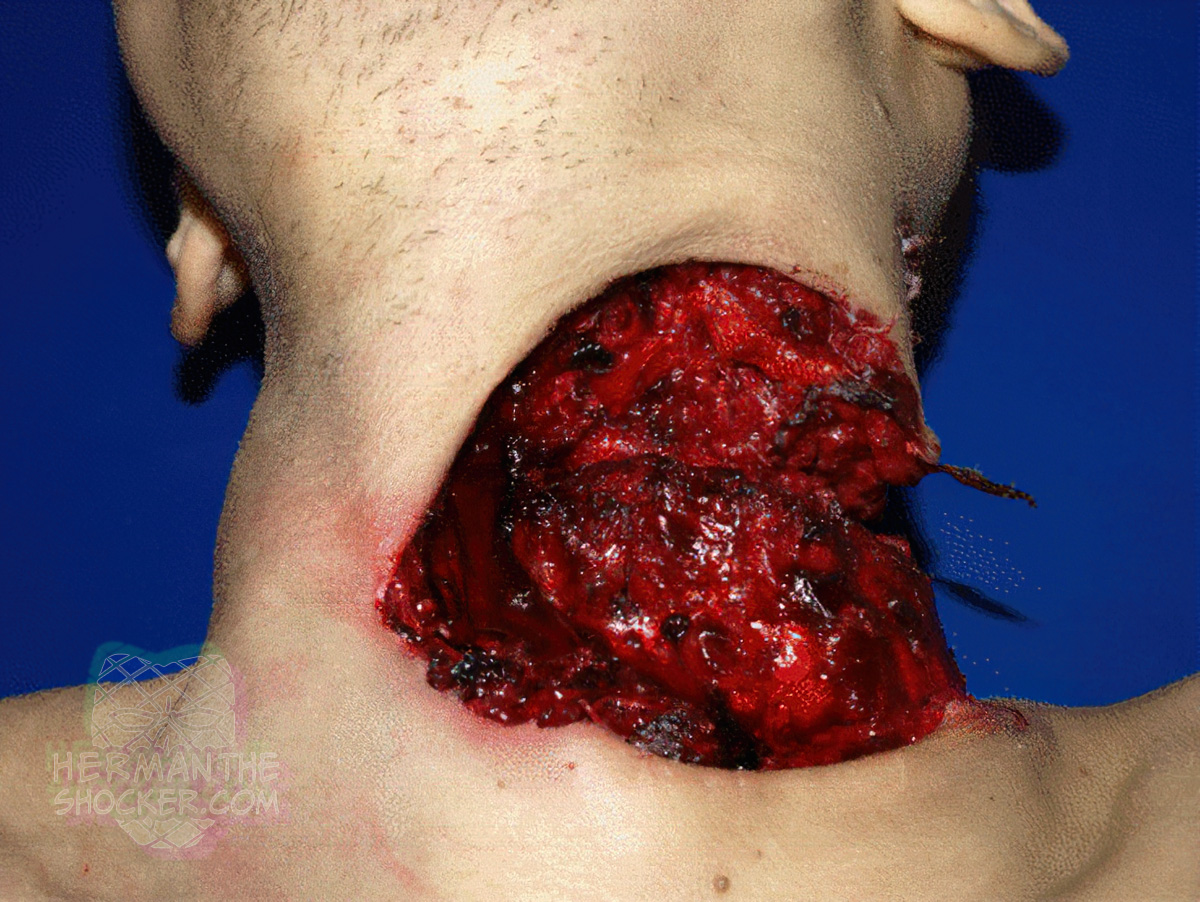 Suicidal cut of the throat by a chainsaw
