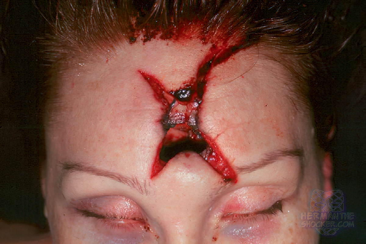 Stellate gunshot wound