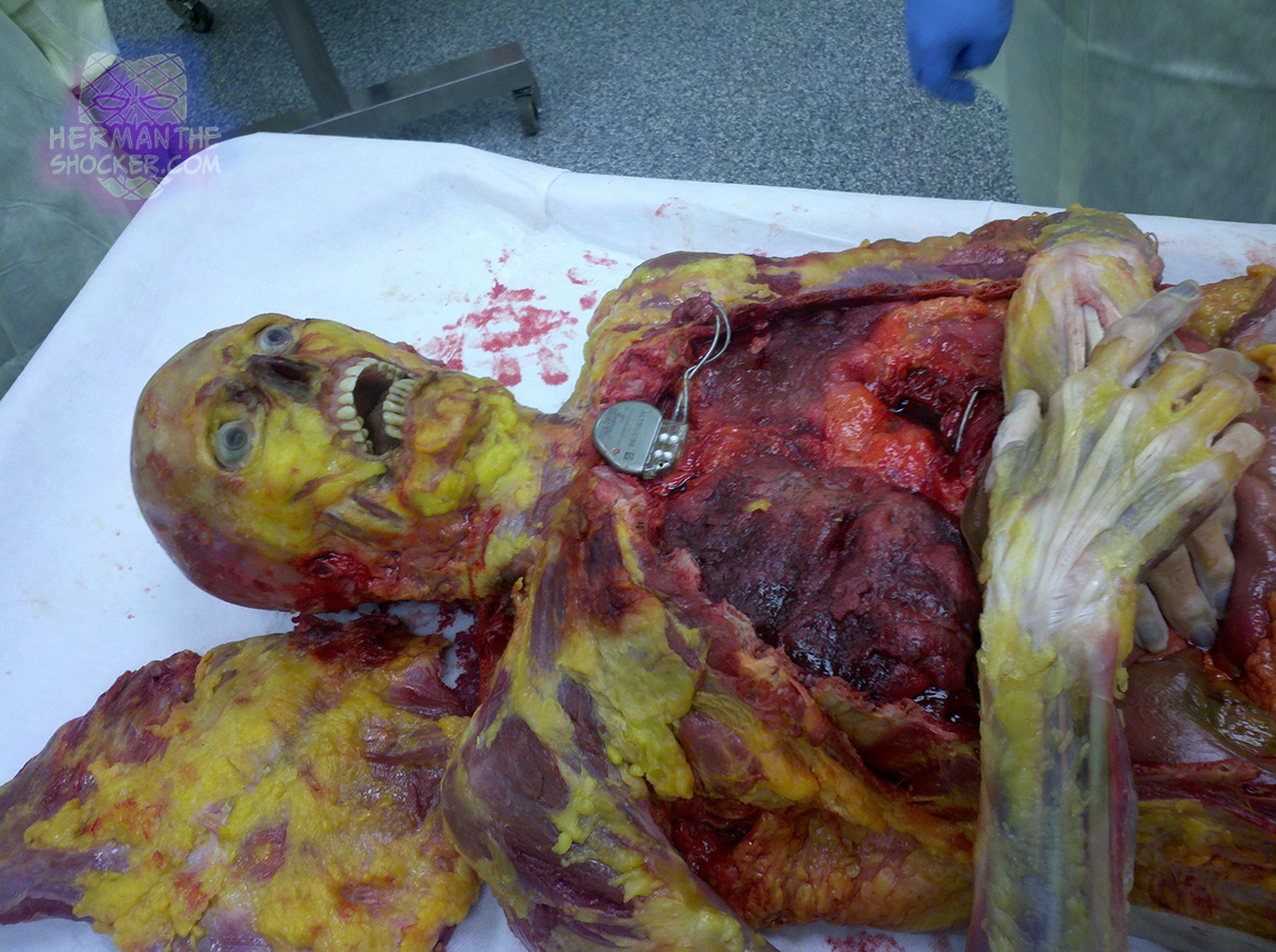 A pacemaker on a cadaver being dissected