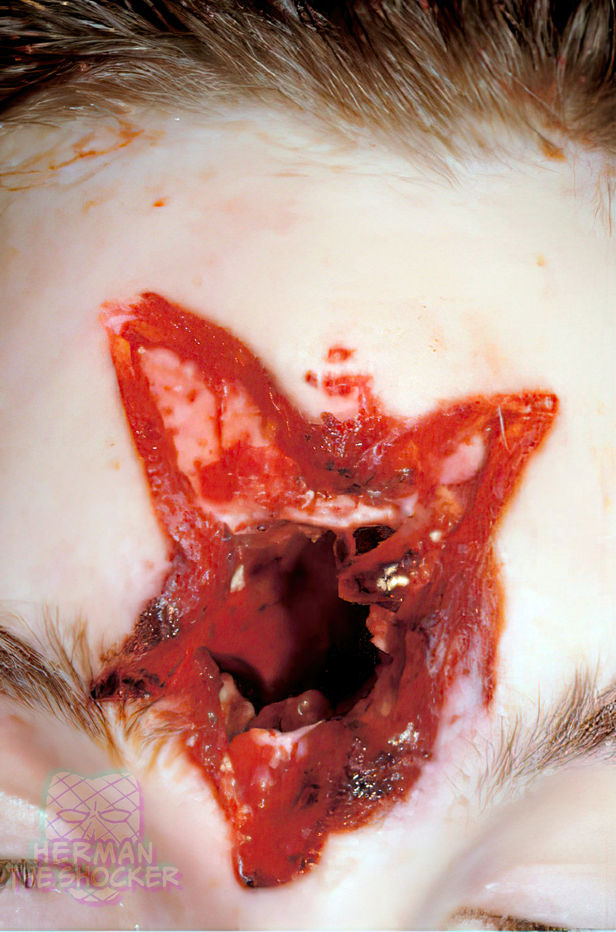 A large stellate contact entrance wound of the forehead