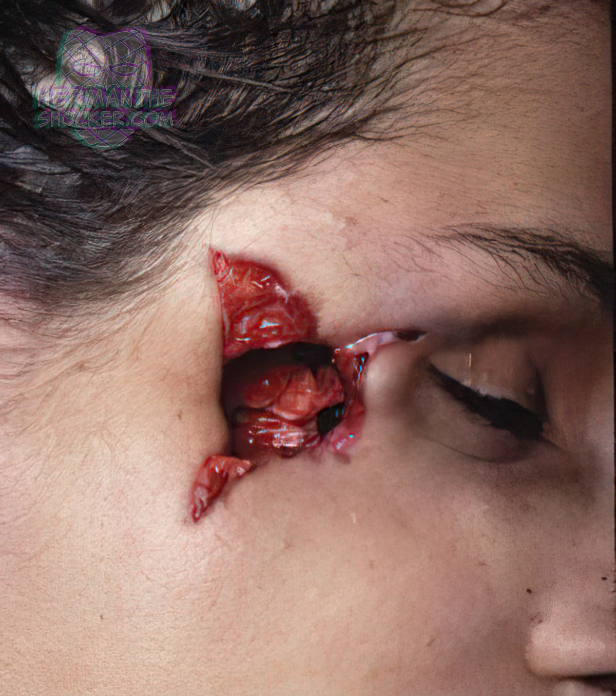 Gunshot Wound From A 357 Magnum Herman The Shocker