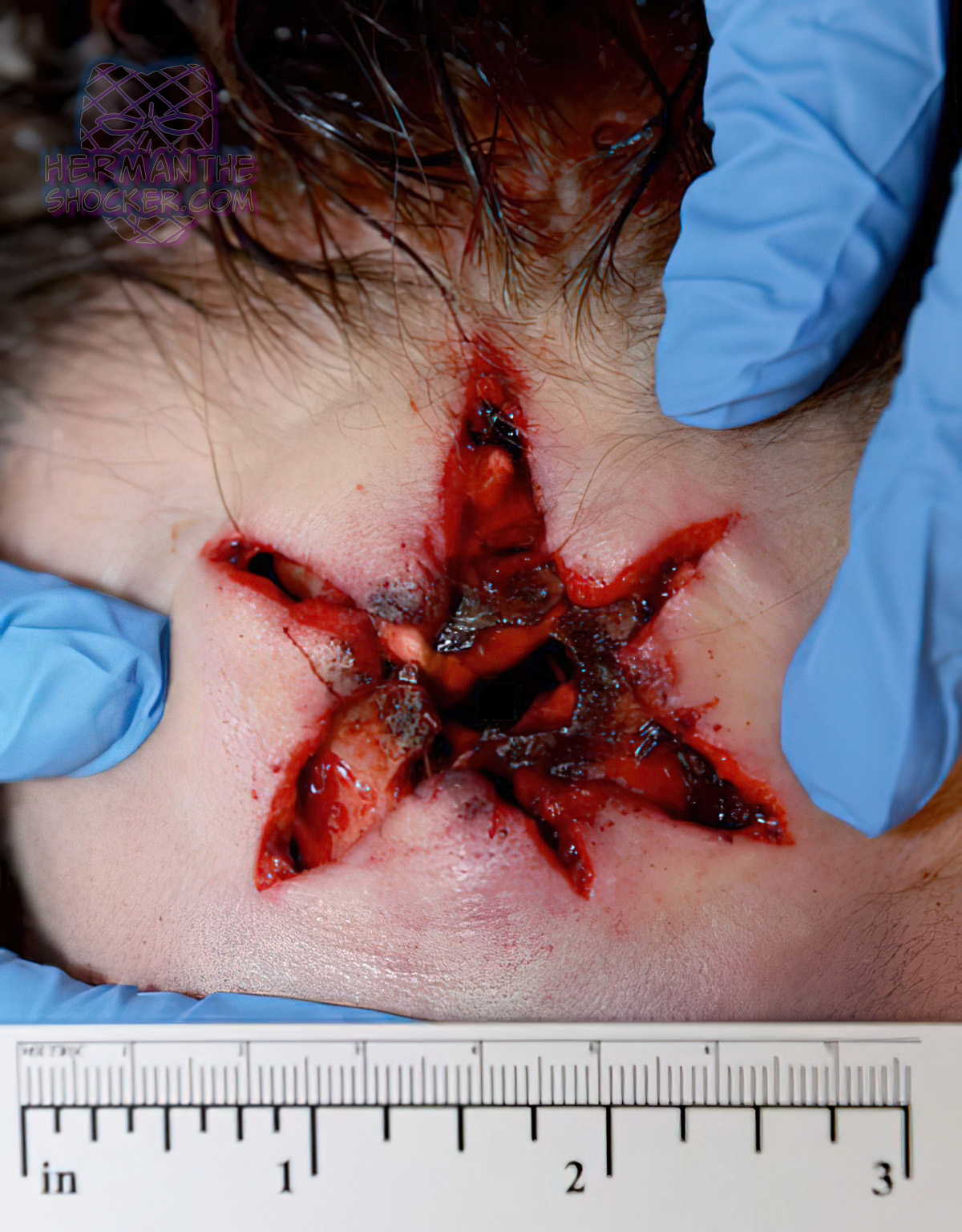 Contact gunshot wound with stellate blow back lacerations