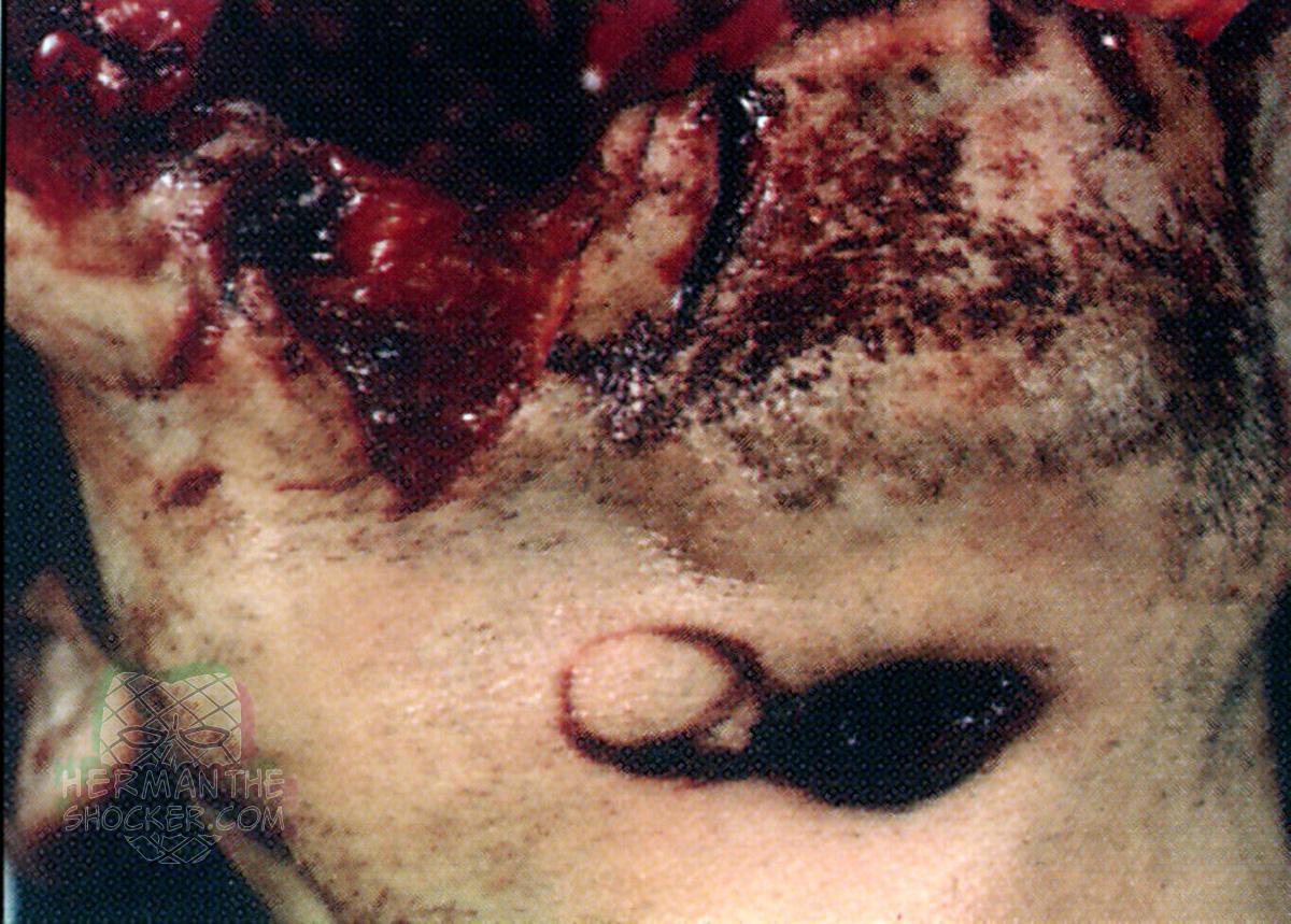 Contact gunshot wound from a shotgun slug