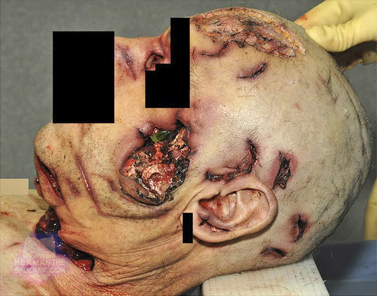 Blunt- and sharp-force trauma in a man fatally assaulted