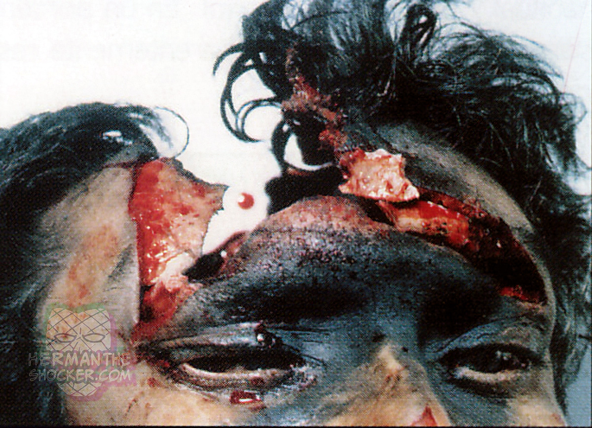Cranial burst from a contact gunshot wound to the forehead