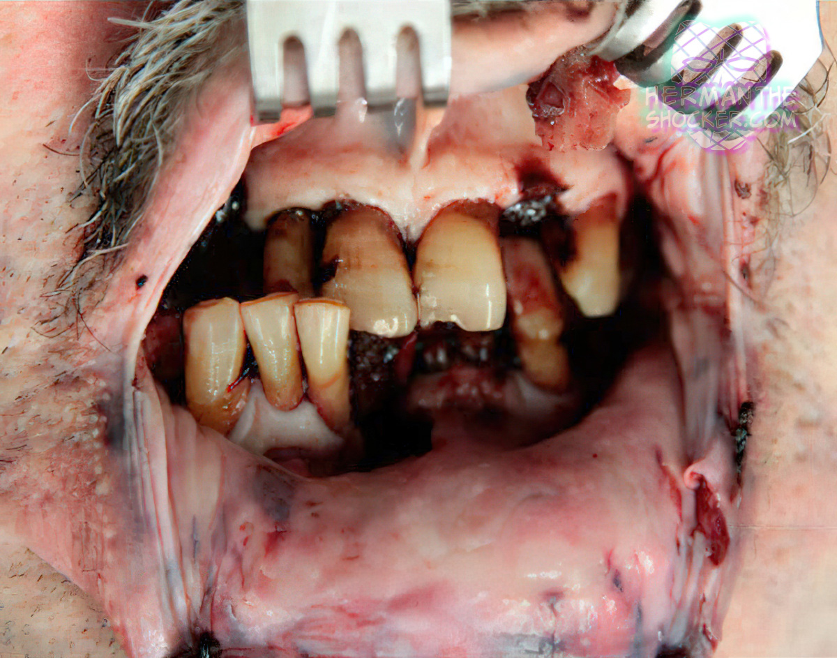 Maxillary fractures caused by shotgun blast