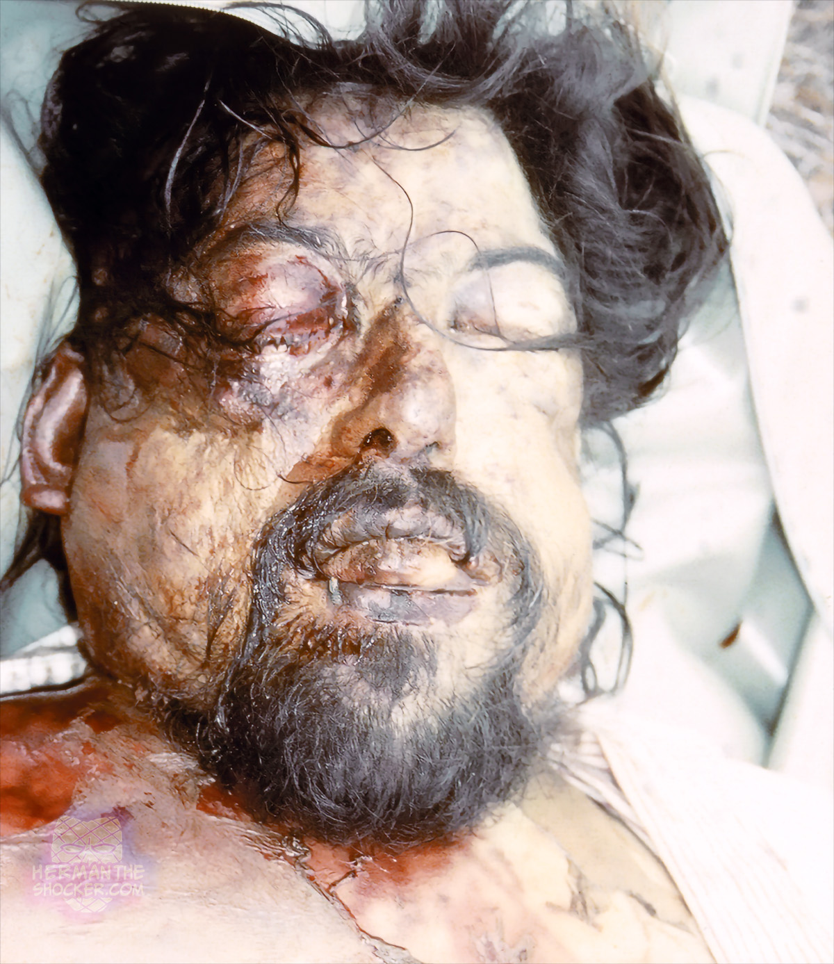 Defleshing the head for visualization of skull injuries