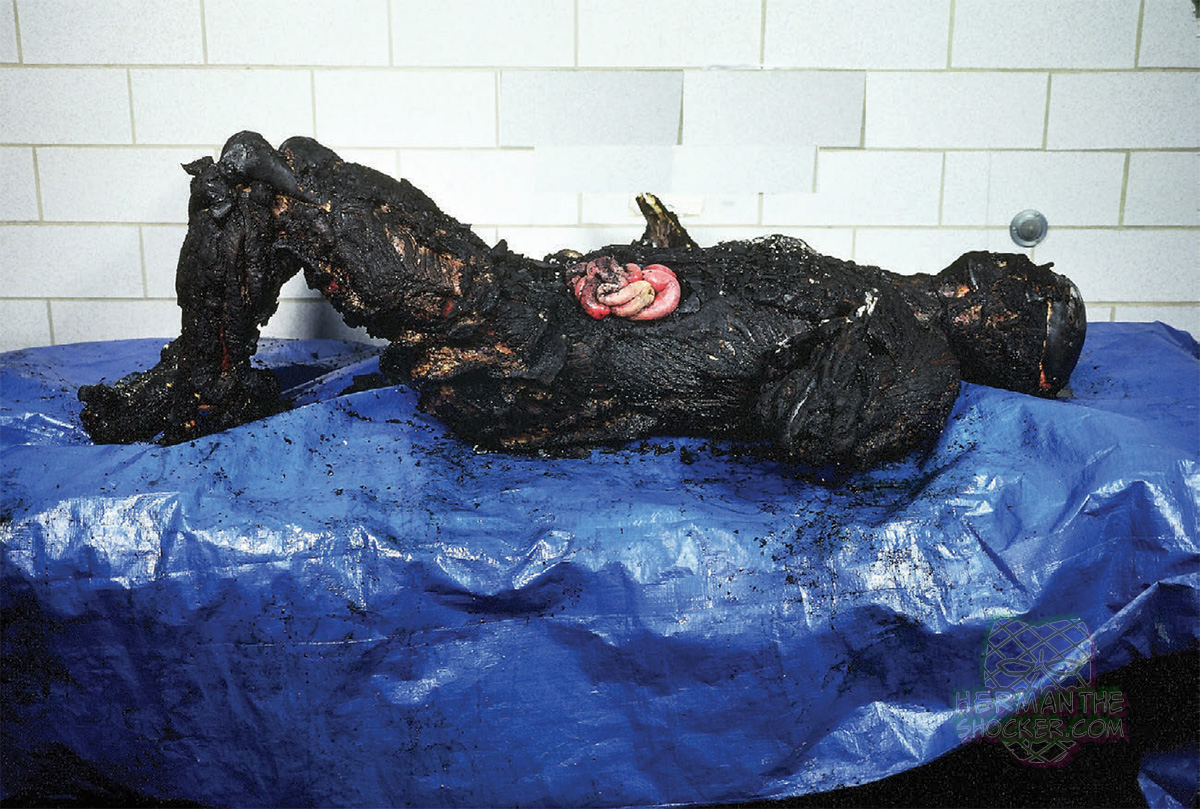 Pugilistic attitude of a burned body